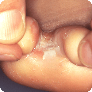 かゆみ ブツブツ 手のひら 手のひらがかゆいのは病気？考えられる８つの原因と対処方法を知ろう！