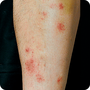 湿疹 皮膚炎 でかゆみが起きる原因は かゆみを伴う皮膚疾患とその対処法 田辺三菱製薬 ヒフノコトサイト