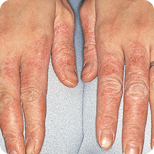 手 指の湿疹 ぶつぶつの原因と対処 治療法 田辺三菱製薬 ヒフノコトサイト
