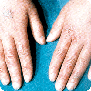 足の指のひび割れの原因と対処 治療法 田辺三菱製薬 ヒフノコトサイト